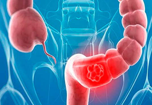 cancer colon colorectal