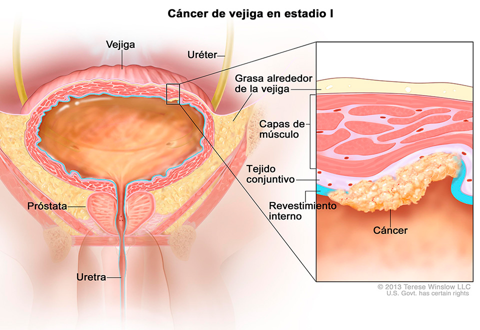 cancer vejiga2