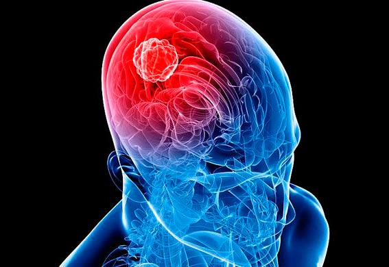 tumor cerebral